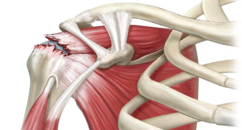Learn about rotator cuff tear